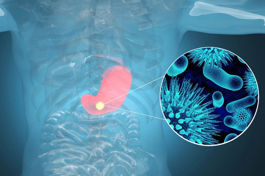 腫瘤標(biāo)記物CA72-4：“胃”，你還好嗎？